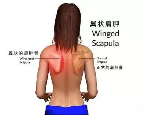 肩胛骨下角与内侧缘在胸椎段有明显突出,最大的特点是显著的不对称