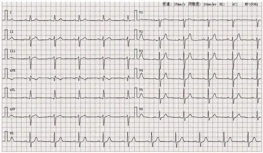 心电图图库丨左前分支阻滞系列