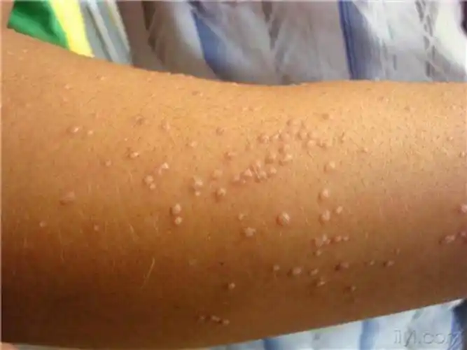 丝状疣的对比图片