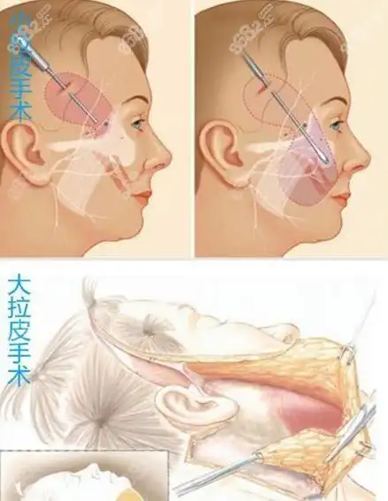 目前较先进的面部提升手术中小拉皮和面部五层提升那个好