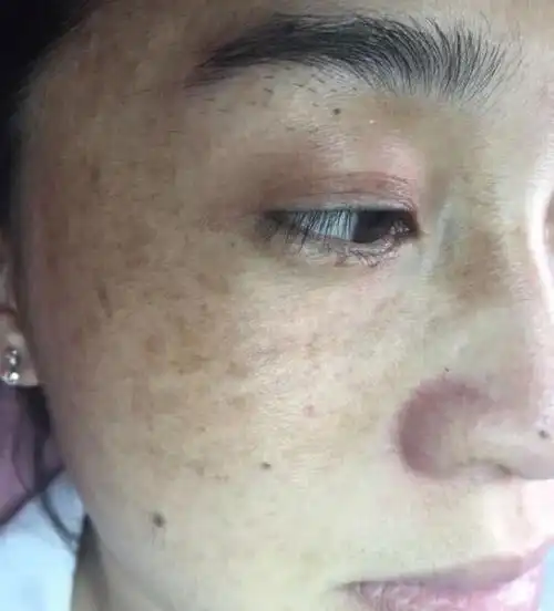 黄褐斑病例咨询回复左脸颊铜钱大小暗灰色面部发黑无光泽