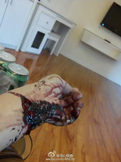 割腕自杀伤口图片