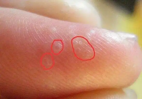 手上起小水泡很痒怎么办