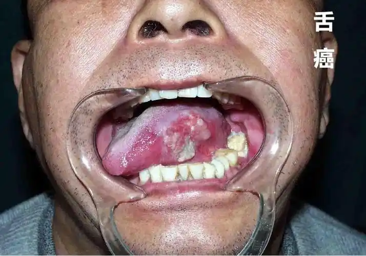 口腔癌的防治