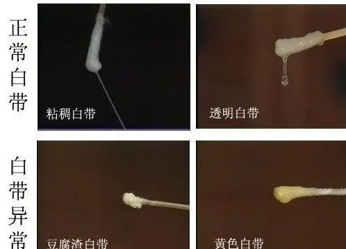 白带乳白色是怎么回事?