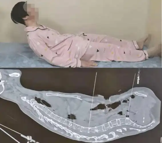 告别十年罗锅昂首挺胸迎来新生