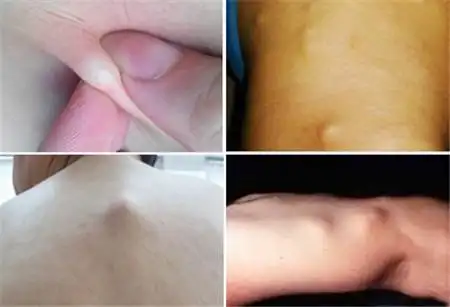 脂肪瘤究竟该如何消除