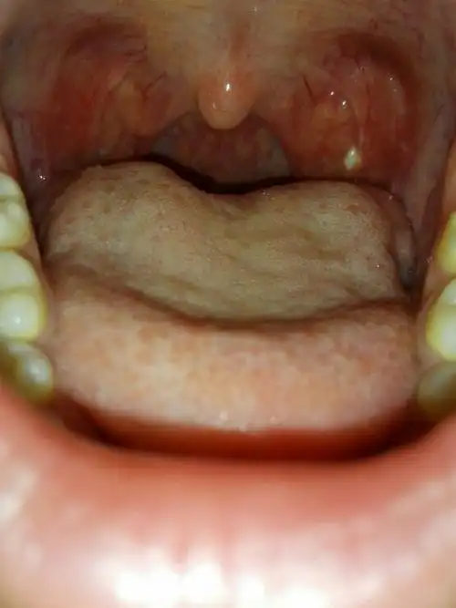 前几天吞咽有点疼痛,看到口腔内壁有个白点,不痛,就是有点膈应.