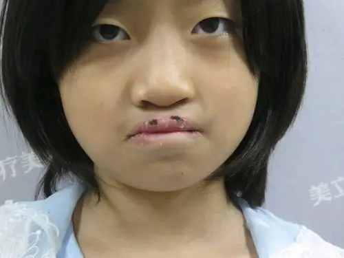 【唇腭裂手术】兔唇/唇腭裂/唇部畸形唇裂修复 唇形塑美 回归自然