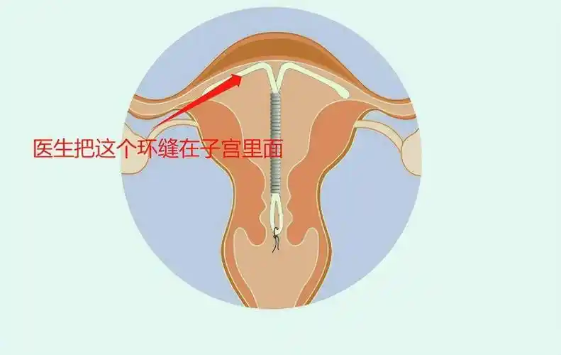 就需要优先取环,通过手术治疗原发病后,再考虑放置曼月乐环