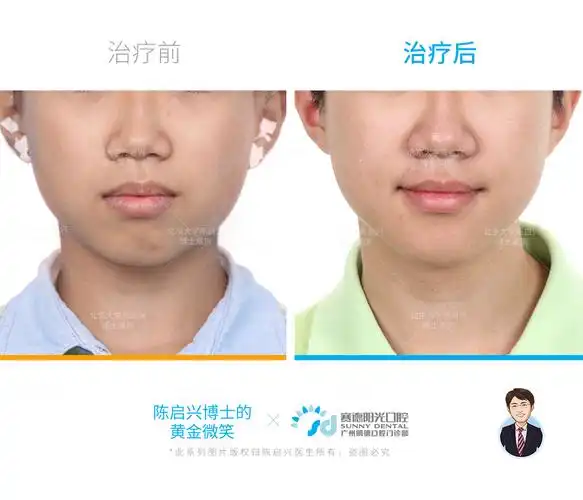 青少年嘴突腺样体面容矫正案例