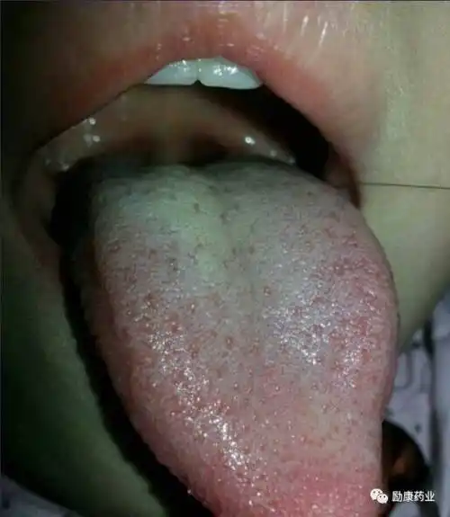 这个孩子已经有了积食的症状,脾胃虚弱.