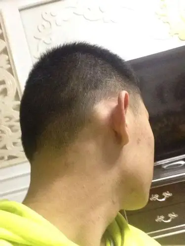 17岁 两个耳朵后面 鼓起来 仔细看较夸张 不疼 也不影响听力 但是影响