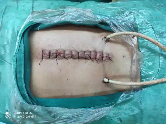 腰椎滑脱症及腰椎峡部裂的微创内窥镜治疗方法_腰椎滑脱_症状表现