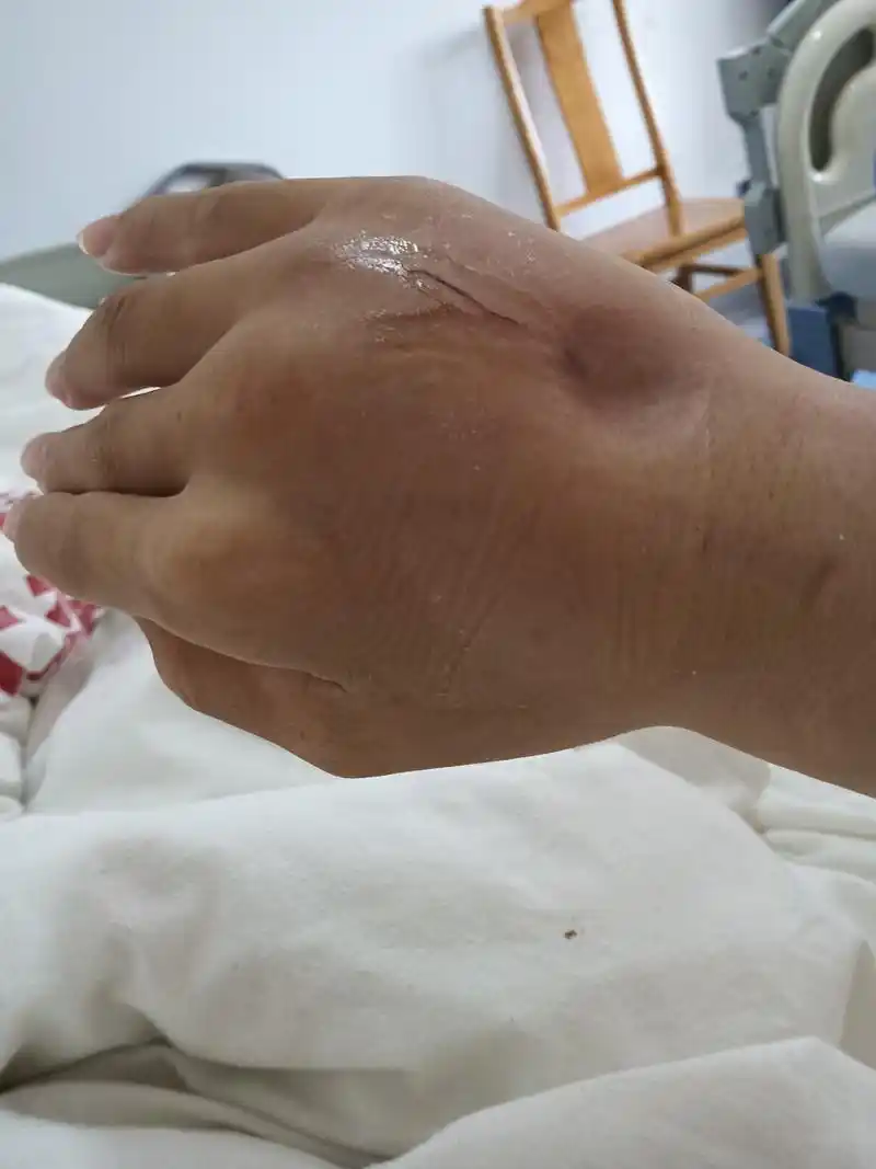 我已经连续吊瓶了10多天了,手都肿了,就像冬天里挨冻的萝卜,钻心的疼