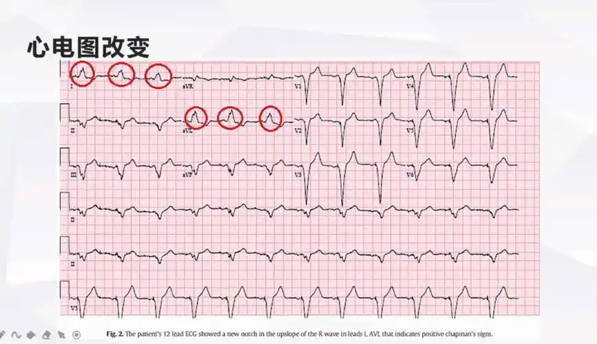 左束支阻滞心电图