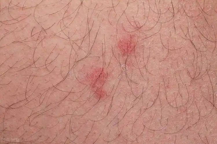 男性龟头炎症状图片怎么样4种龟头炎溃烂图片