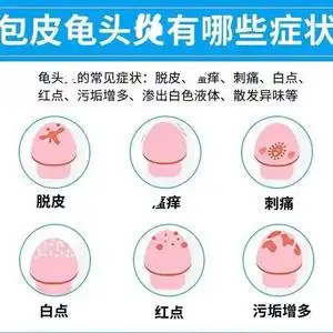 龟头炎霉菌性包皮炎膏珍珠疹白垢冠状沟红点阴茎痒男性喷剂药柜膏