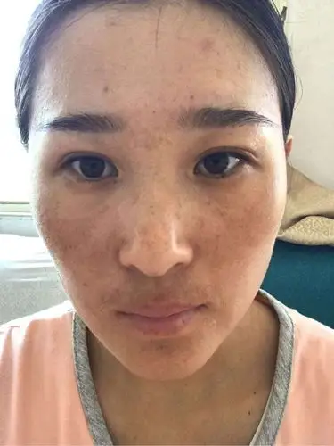 生完宝宝后一脸的斑