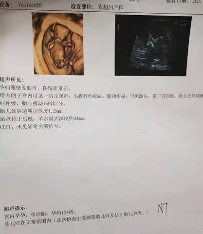 育儿问答 怀孕期 刚做完nt 中间那个是脐带嘛,大家可以看出是男宝还是