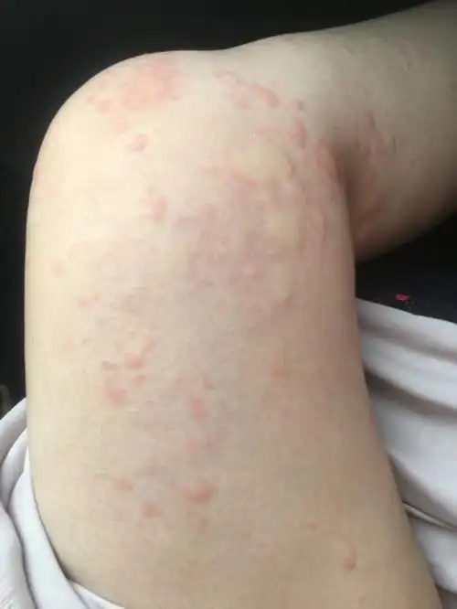 患有寒冷性荨麻疹的朋友你们有治愈的吗