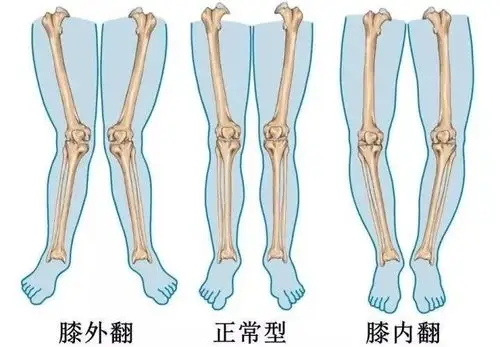 孩子x,o型腿,只因爸妈忽略了这些!