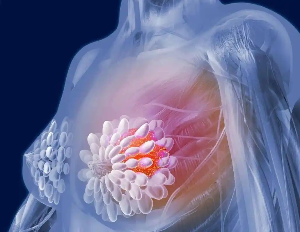 女人乳腺增生危害大,三伏是最佳治疗时机!灸除乳腺地雷,做健康女人!_