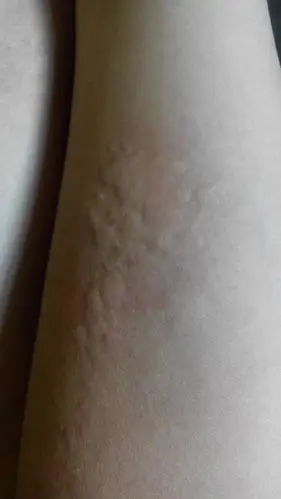 不知道怎么了中午睡觉痒起来的 全身有些包痒的不行