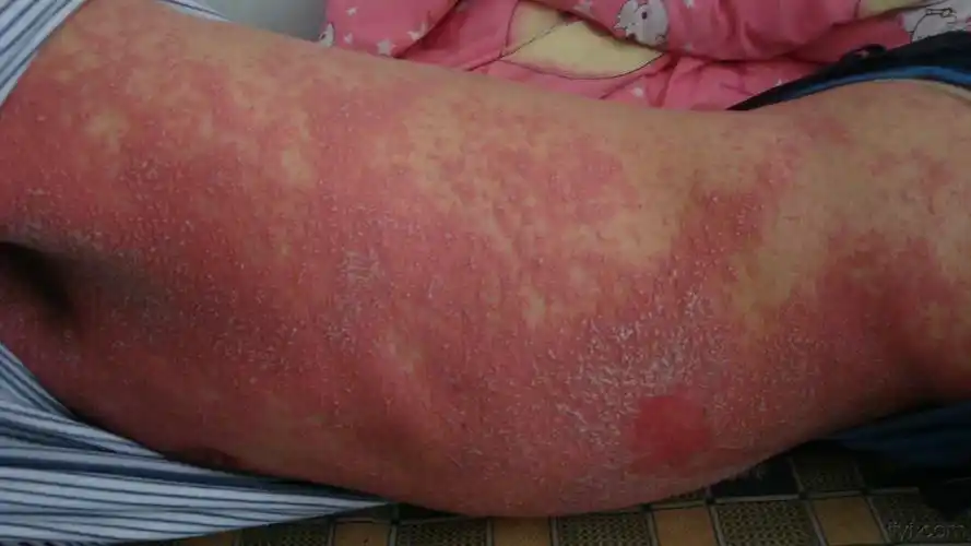 腹股沟以上的皮肤病变,请诊断