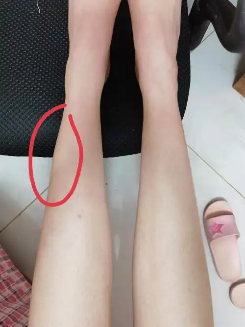 小腿一边有个肿块?
