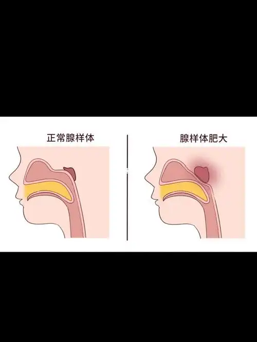 6015腺样体肥大的根本原因是:积