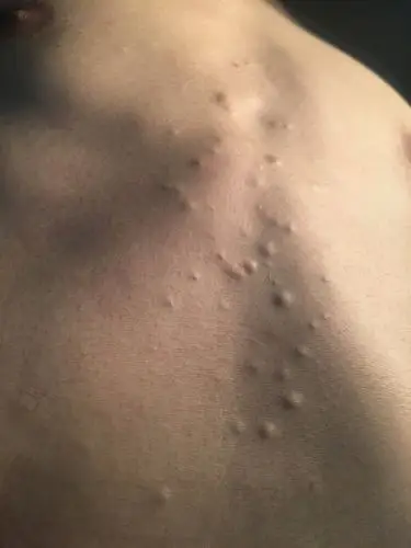 似痘非痘:多发性脂囊瘤_皮脂腺囊肿_介绍_症状表现 - 好大夫在线