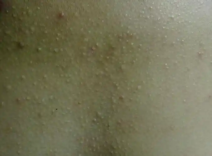 胸口长脂肪粒[肉疙瘩]求治疗