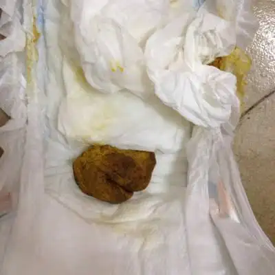 八个月几天的宝宝拉这样干的粑粑不正常吧?