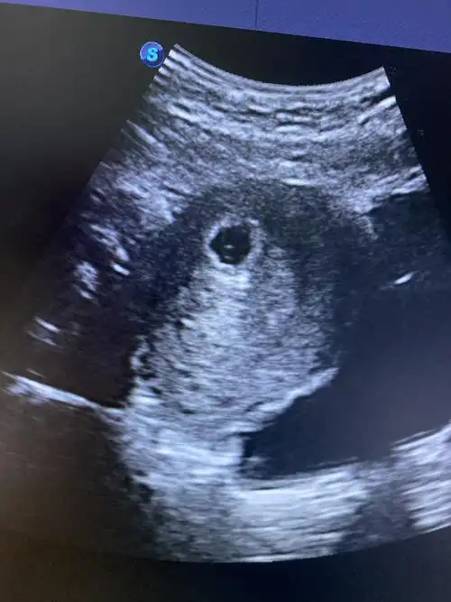 拍的孕囊,现在有两个闺女,想要个皮夹克,这个孕囊能看出来男孩女孩吗?