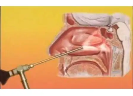 等离子射频消融术治疗腺样体肥大