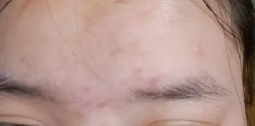 额头上长了这些小包包,红肿的,是痘痘还是粉刺还是什么啊?