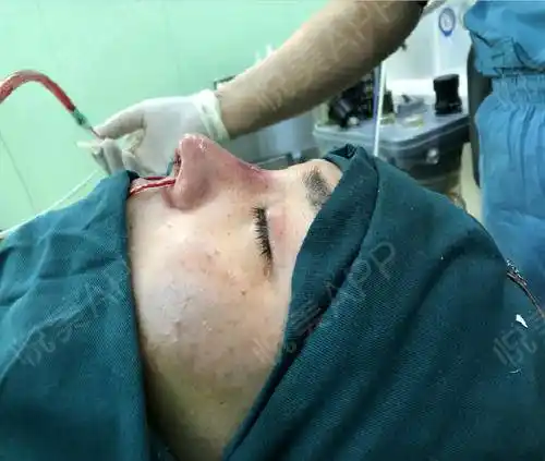 鼻综合整形手术当天_自体肋软骨隆鼻手术当天_垫鼻尖手术当天_垫鼻