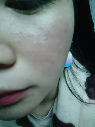 脸部过敏怎么办啊啊啊啊啊啊啊而且很痒又不敢抓.请求帮助