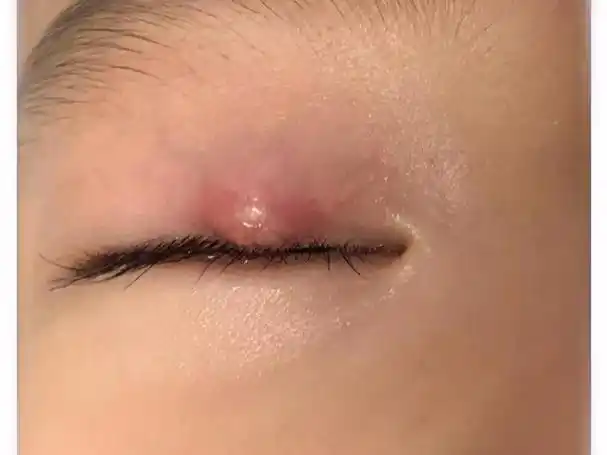 孩子眼皮长包怎么办,眼科医生教您如何区分霰粒肿与麦粒肿
