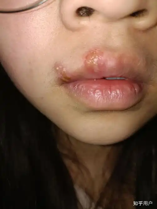 嘴角起小水泡怎么回事(嘴角起小水泡怎么回事图片)