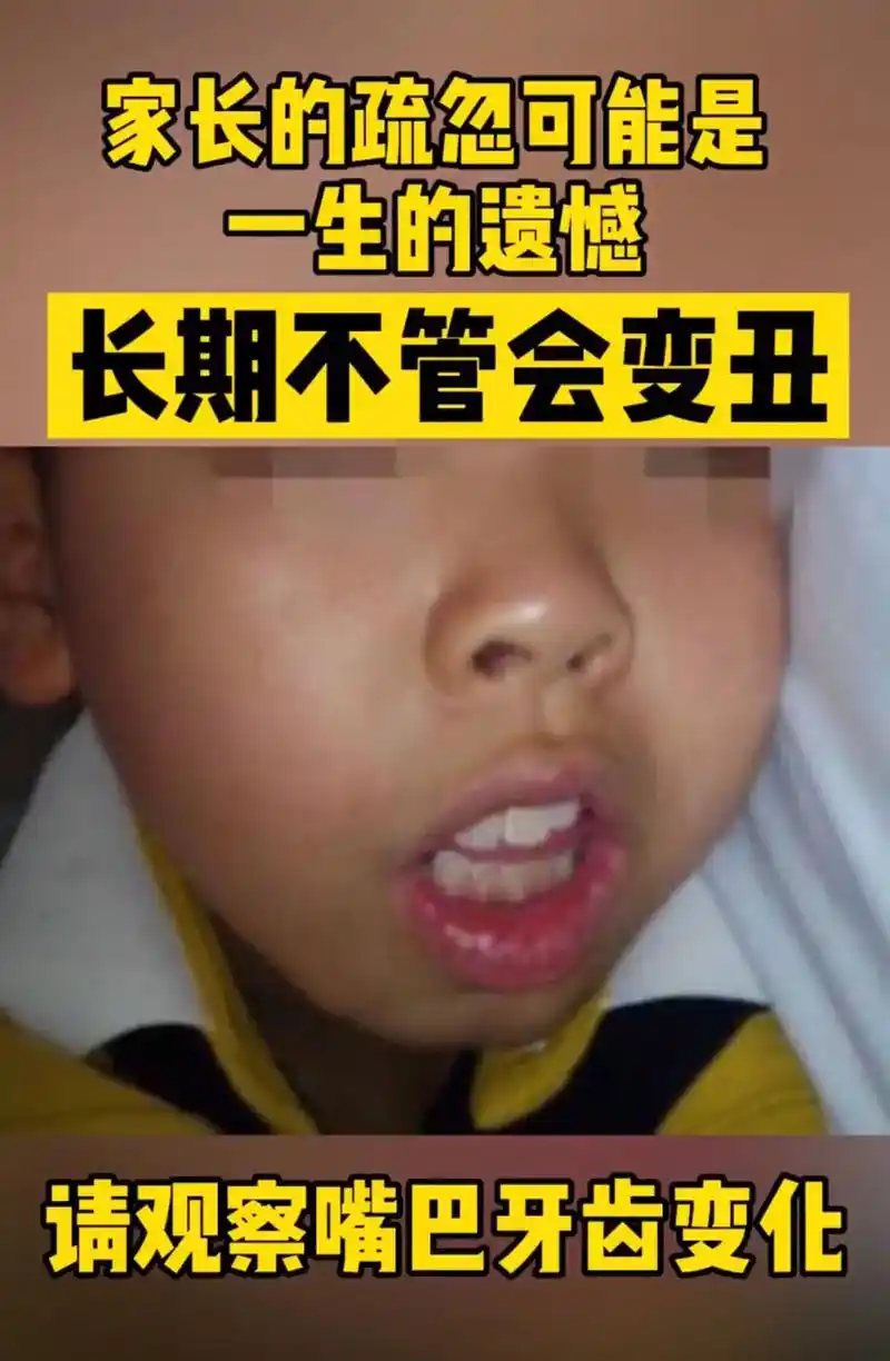 腺样体面容不可忽视 - 耳鼻喉医生周诗侗 - 抖音