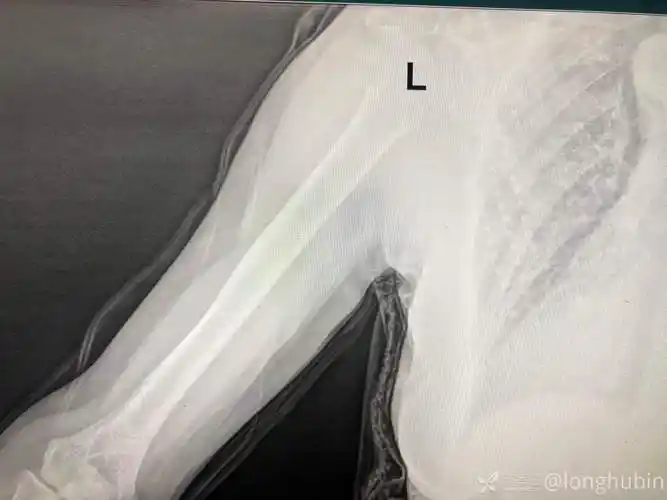 左侧肱骨外科颈骨折