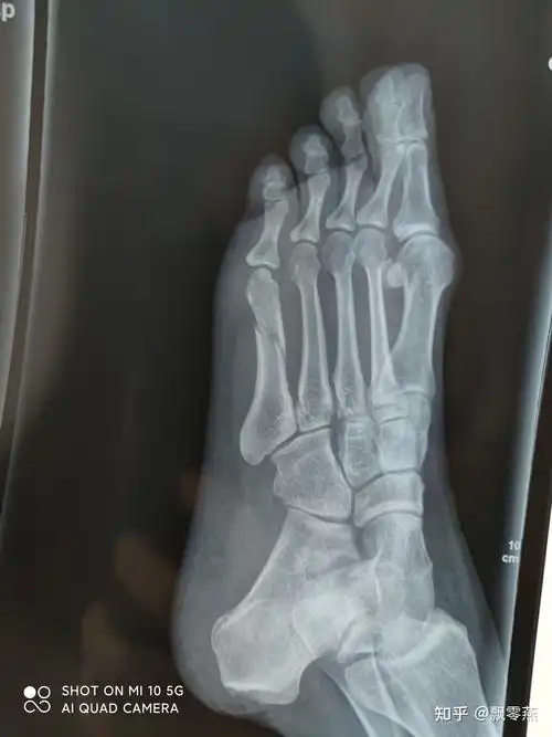 脚第5跖骨骨折35 - 知乎