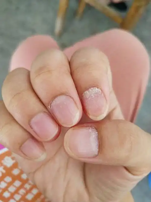 手指甲总是出现这样的情况,有人知道这是怎么回事嘛?