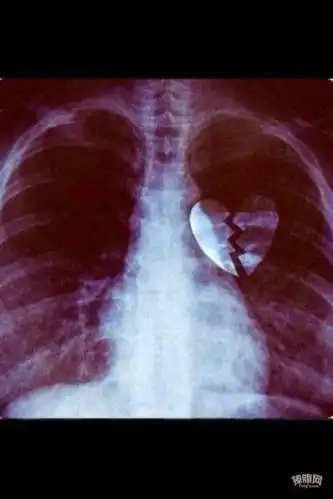 今天去医院拍片了, 貌似很严重