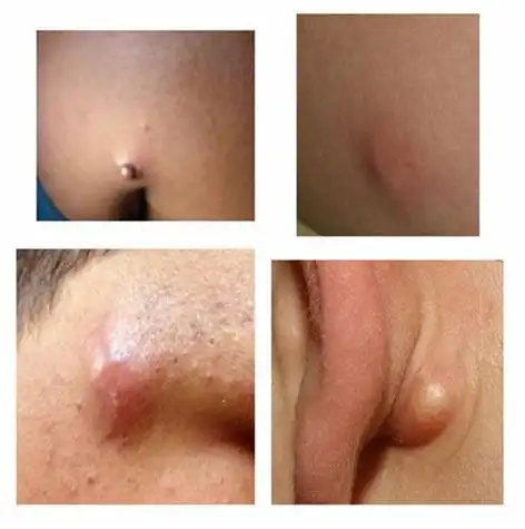 有些比较小的囊肿是有可能会自己好起来的,一般情况下分为良性囊肿和