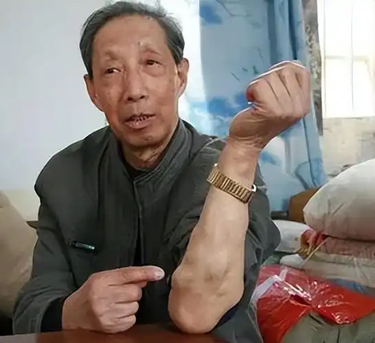 脂肪瘤对人体有多大危害?会不会癌变?医生告诉您