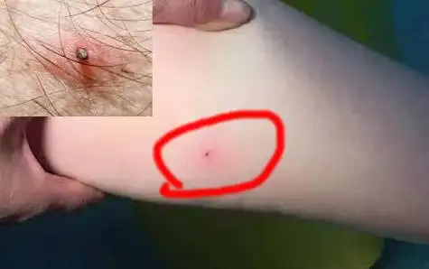 1,出现红肿蜱虫子咬人图片1被蜱虫叮咬之后,皮肤上会有明显的红肿,和