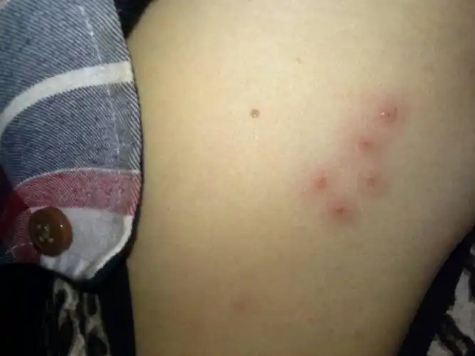 这个包包又是什么? 腋窝偏下长了5个疙瘩.